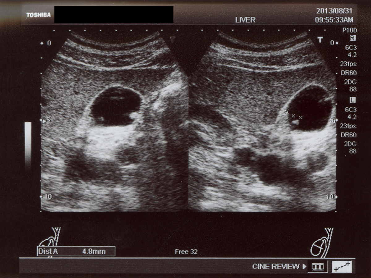 胆石症ブログ：腹部超音波検査で見つかった小さな結石のお話